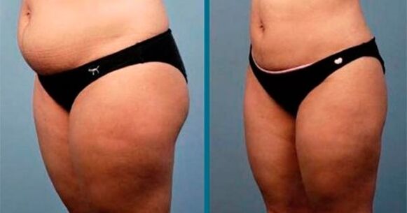 metódy na zníženie hmotnosti o 10 kilogramov za mesiac